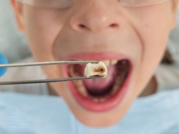 Best Urgent Tooth Repair  in Whitewater, CA